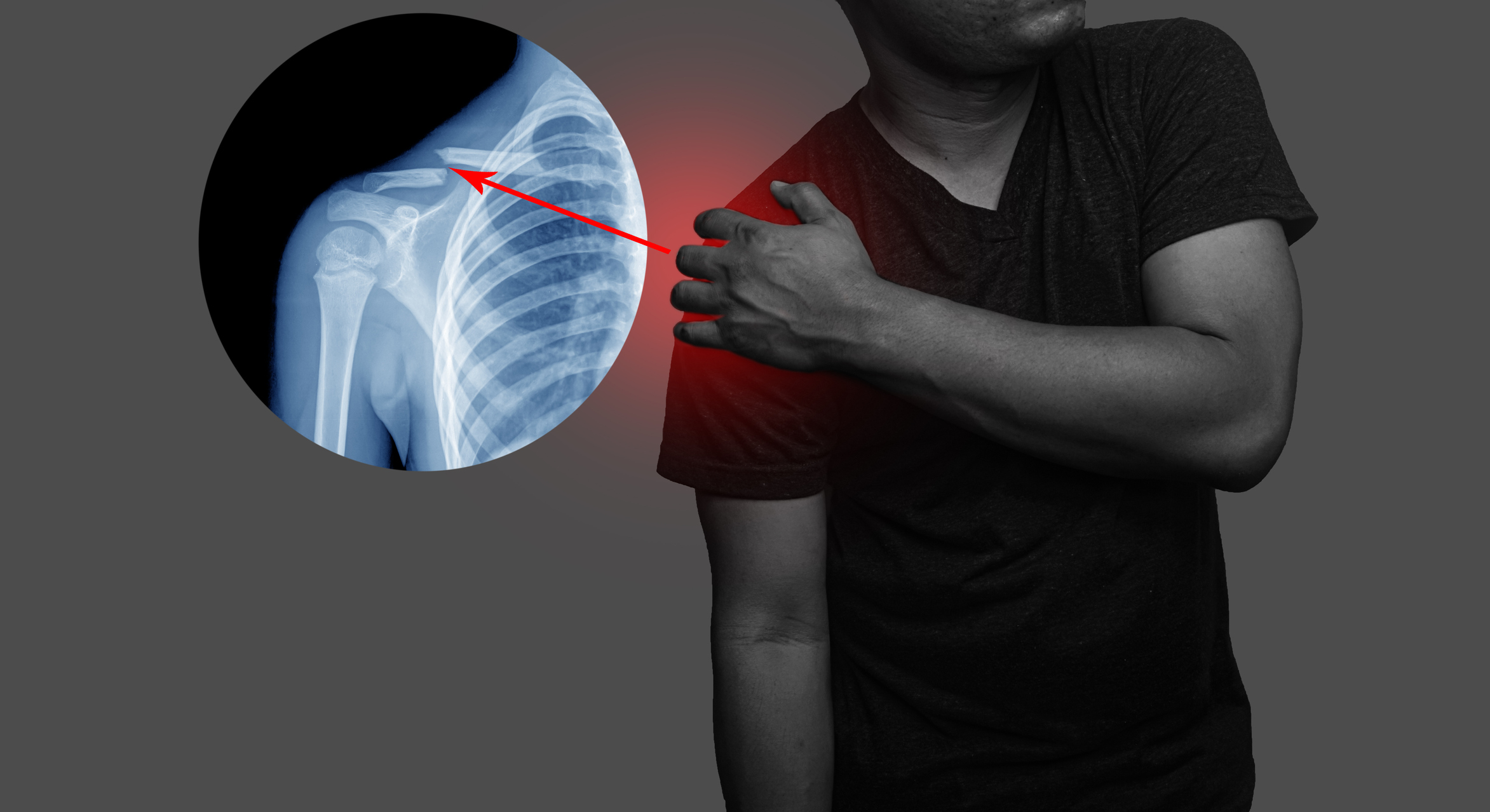 Signs You May Have A Broken Collarbone Advantage Orthopedic And 